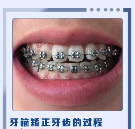 中日友好医院矫正牙齿怎么样？三甲硬核实力+真实案例，北京正畸首选不踩坑