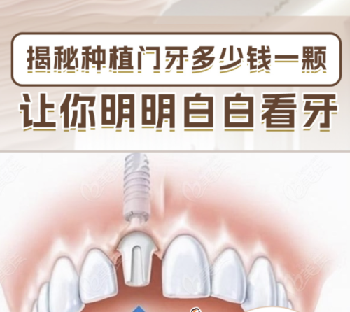 山东大学口腔医院牙齿种植多少钱？2025价目表+真实案例揭秘