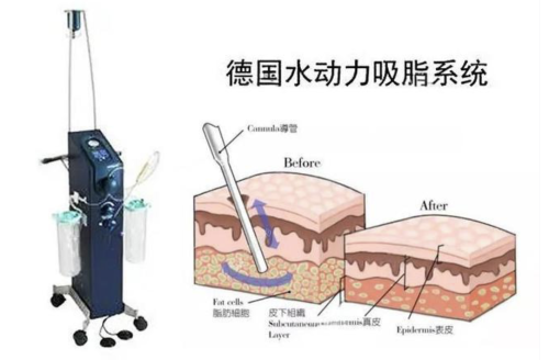 超声吸脂和水动力吸脂哪个好？没有最优解，只有最适配