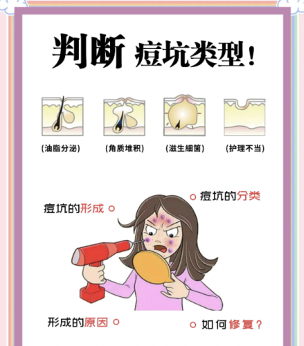 脂肪填充修复痘坑有效果吗？4个核心问题，新手必看