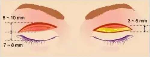 双眼皮 双眼皮
