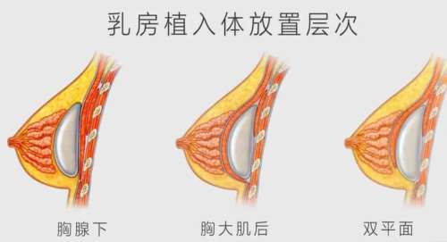 【隆胸咨询】全国隆胸医院医生资质优惠价格在线咨询预约