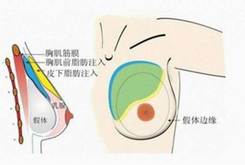 【胸部整形咨询】隆胸整形医院医生免费在线咨询