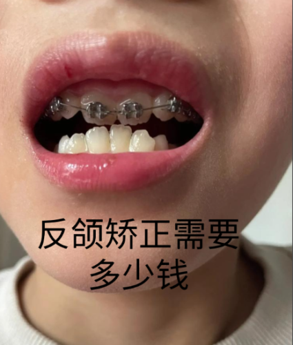 反颌矫正需要多少钱？2025超全报价清单，别再花冤枉钱