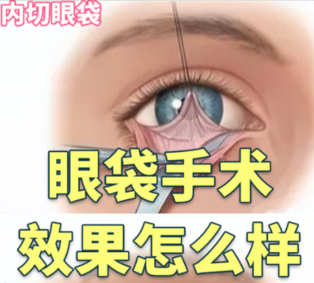 内路去眼袋效果好吗？2024实测真相：谁适合、能维持多久、避坑指南