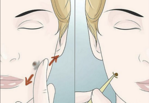 酒窝整形有危险吗？3个真实案例+2份论文数据，帮你看清风险与安全边界