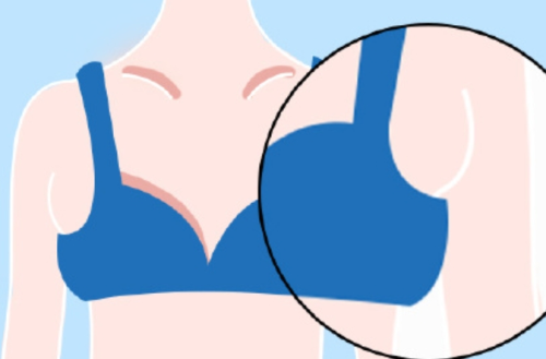 副乳吸脂和切除的区别，穿内衣总磨得慌？腋下小包块方案怎么选才更稳