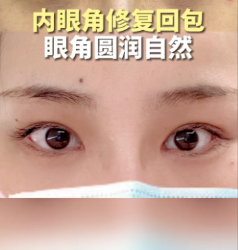 内眼角回包多久恢复自然？拆穿恢复期的“时间密码”+真人案例干货