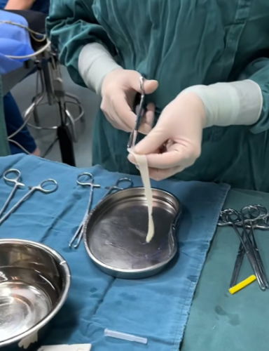 3d束带紧缩术什么时候做最好？医生专业建议+时间规划