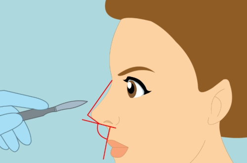 综合鼻部整形看得出不？这几个细节最容易暴露