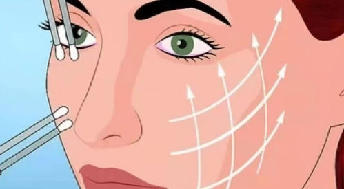 微拉美和筋膜提升哪个效果最好？适合人群和恢复期全面对比