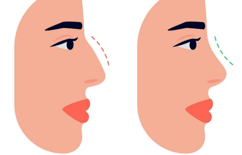 耳软骨隆鼻和线雕隆鼻哪个好?稳定度和鼻型表现差别明显吗